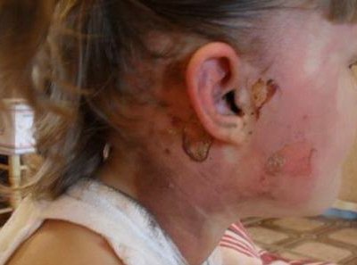 В детском саду «Тополек» п.Юный девочка в возрасте 6 лет получила ожоги тел ...